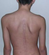 脊柱侧弯患者症状图